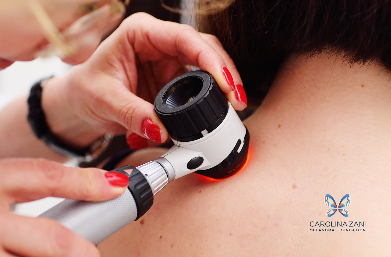 melanoma skin cancer